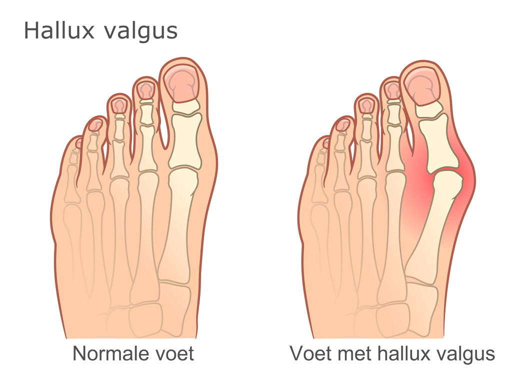 Hallux Valgus Scheefstand Grote Teen Behandeling